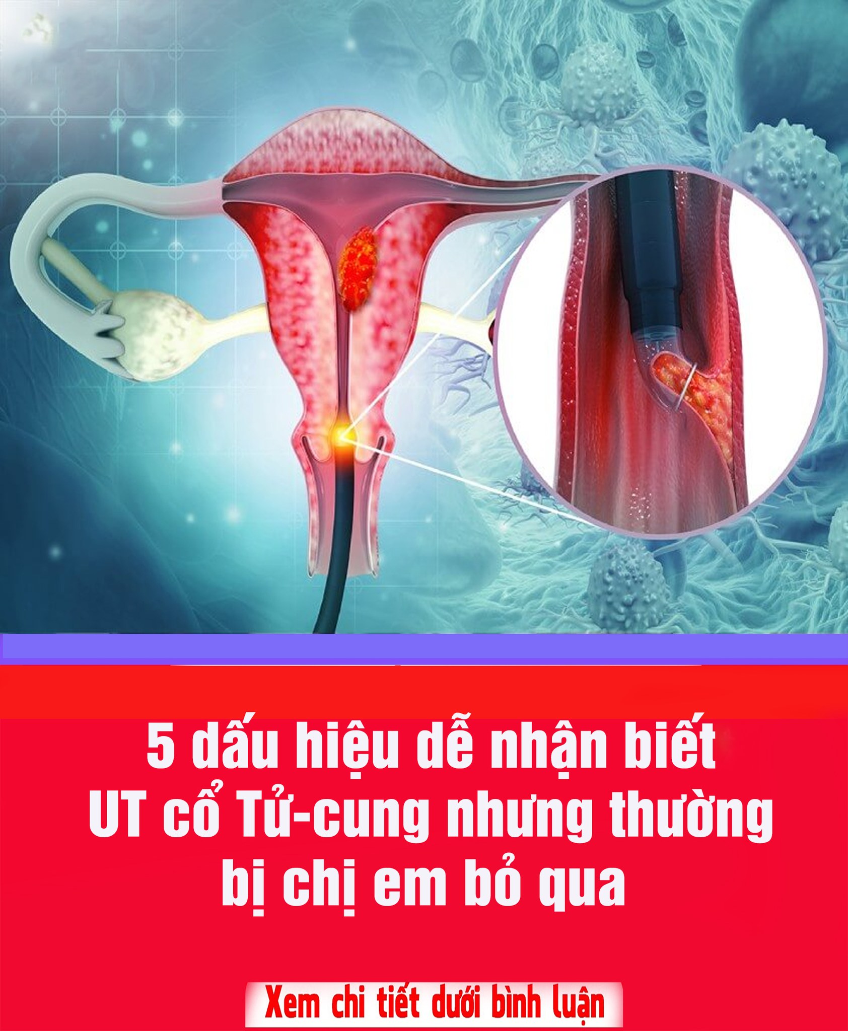5 dấu hiệu u-ng thư cổ t-ử cung sớm nhất: 90% chị em xem thường bỏ qua