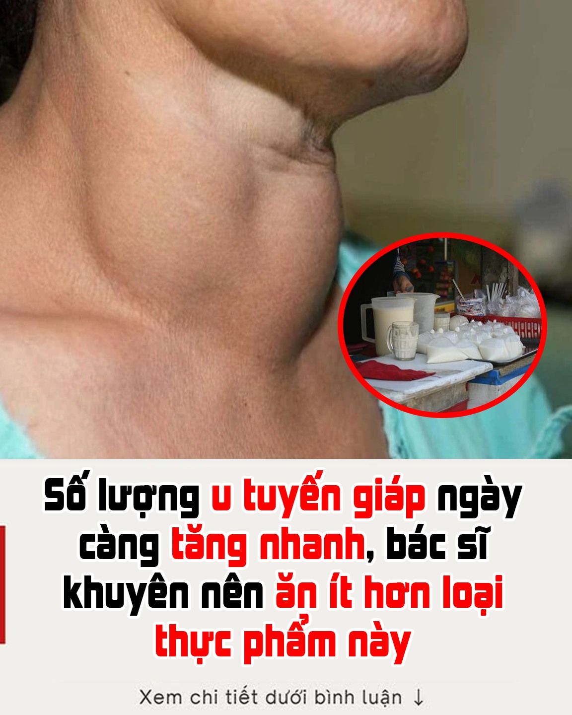 Số lượng u tuyến giáp ngày càng tăng nhanh, bác sĩ khuyên nên ăn ít hơn loại thực phẩm này